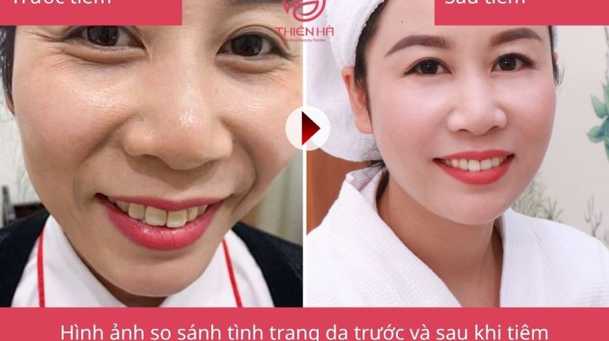Filler Botox là gì? Tác dụng, ưu nhược điểm và quy trình thực hiện