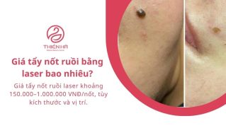 Giá tẩy nốt ruồi bằng laser bao nhiêu? Bảng giá chi tiết