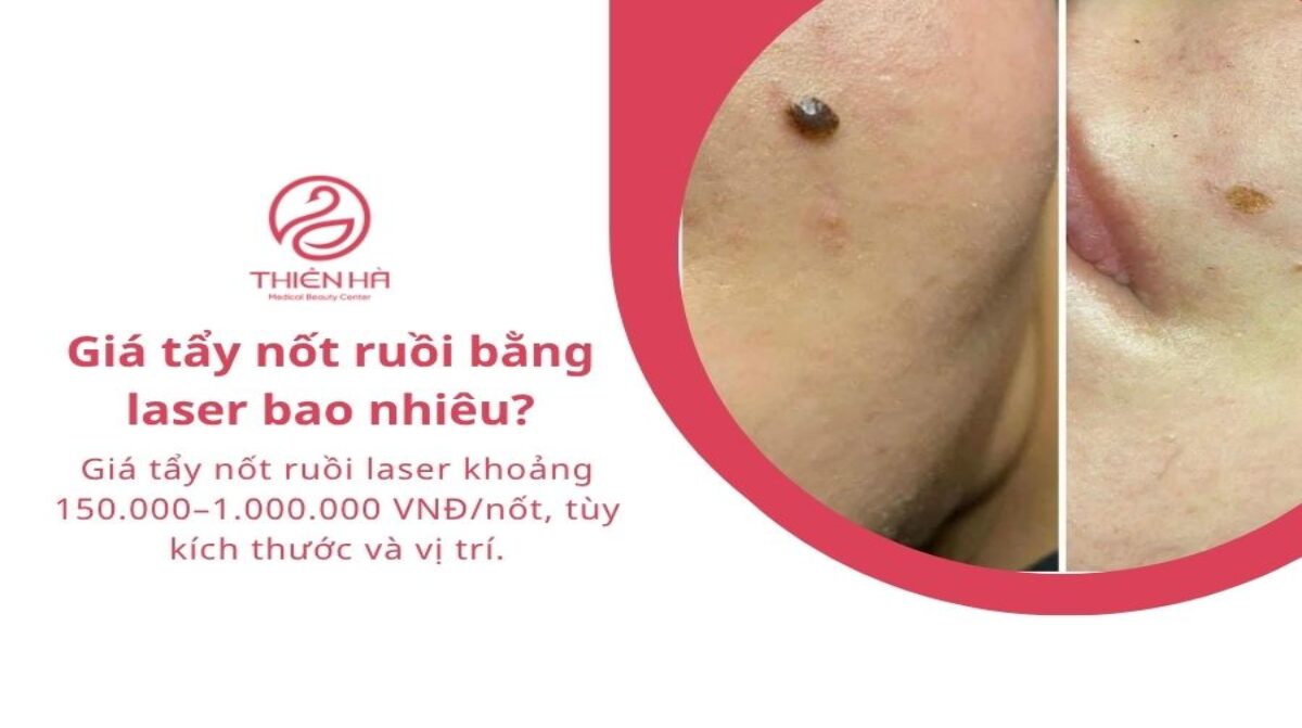 Giá tẩy nốt ruồi bằng laser bao nhiêu? Bảng giá chi tiết
