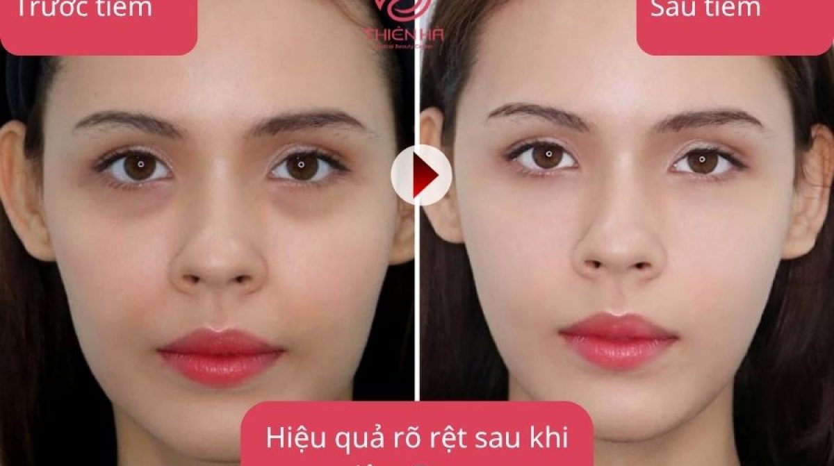 Tiêm Botox Giá Bao Nhiêu? Bảng Giá Chi Tiết & Ưu Đãi Mới Nhất Tại TMV Thiên Hà