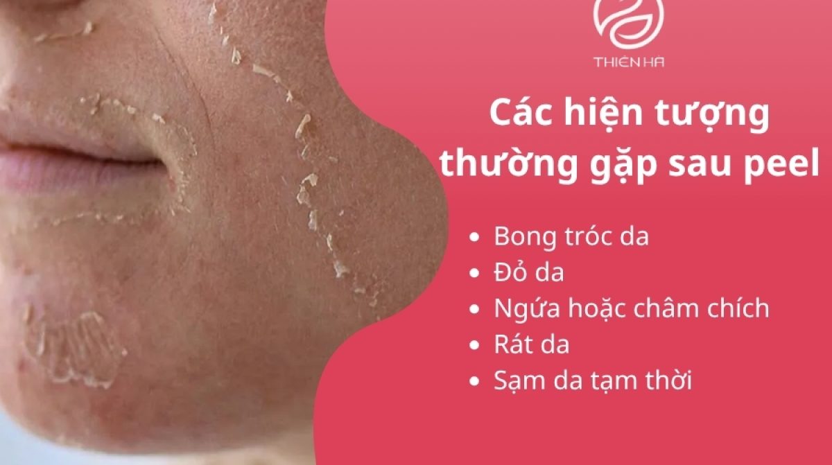 Hiện tượng sau khi peel da: Quá trình bong tróc & chăm sóc