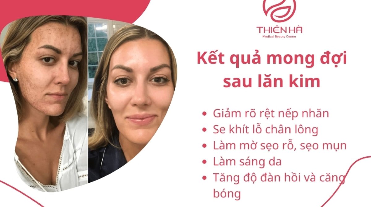 Hình ảnh da mặt sau lăn kim: Quá trình phục hồi và kết quả
