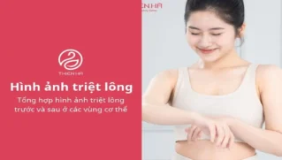 Tổng hợp hình ảnh triệt lông trước và sau ở các vùng cơ thể