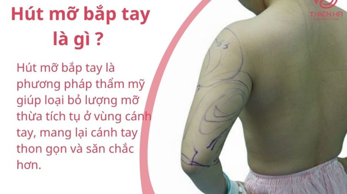 Hút mỡ bắp tay là gì? Quy trình, chi phí và lưu ý an toàn cần biết