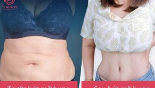 Hút mỡ bụng: Ưu điểm, rủi ro tiềm ẩn và tiêu chí chọn nơi uy tín