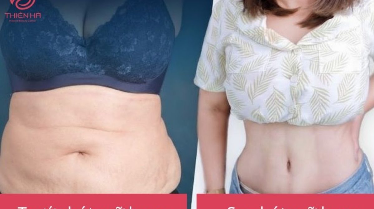 Hút mỡ bụng: Ưu điểm, rủi ro tiềm ẩn và tiêu chí chọn nơi uy tín