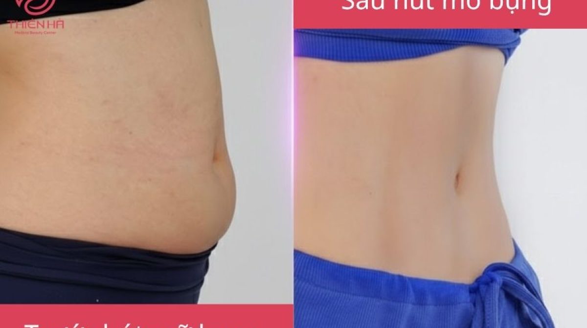 Hút mỡ bụng bao nhiêu tiền? Bảng giá chi tiết mới nhất hiện nay