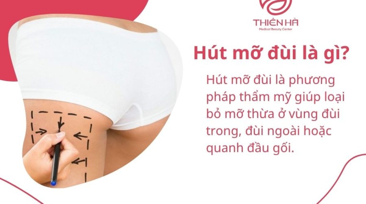 Hút mỡ đùi là gì? Quy trình, chi phí và hiệu quả thực tế