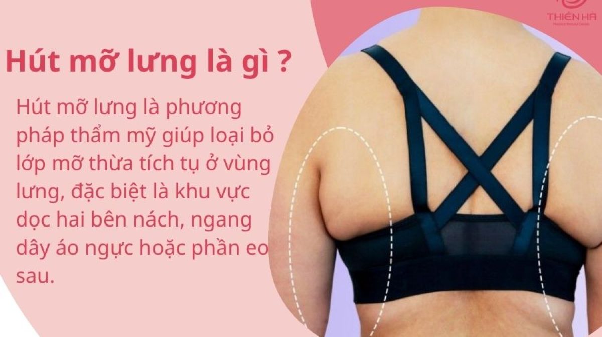 Hút mỡ lưng là gì? Giải pháp giúp tấm lưng phẳng mịn, thon gọn