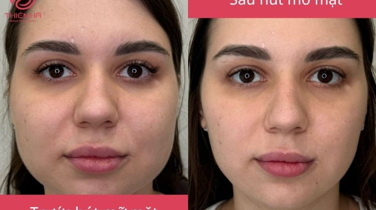 Hút mỡ mặt là gì? Giải pháp thu gọn khuôn mặt nhanh, an toàn