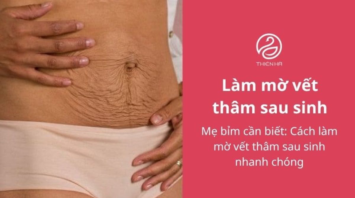 Mẹ bỉm cần biết: Cách làm mờ vết thâm sau sinh nhanh chóng