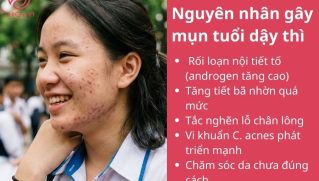 Làm sao để hết mụn tuổi dậy thì? Giải pháp an toàn cho teen