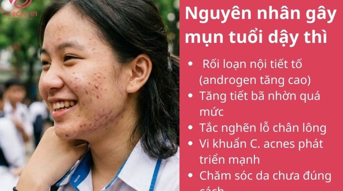 Làm sao để hết mụn tuổi dậy thì? Giải pháp an toàn cho teen