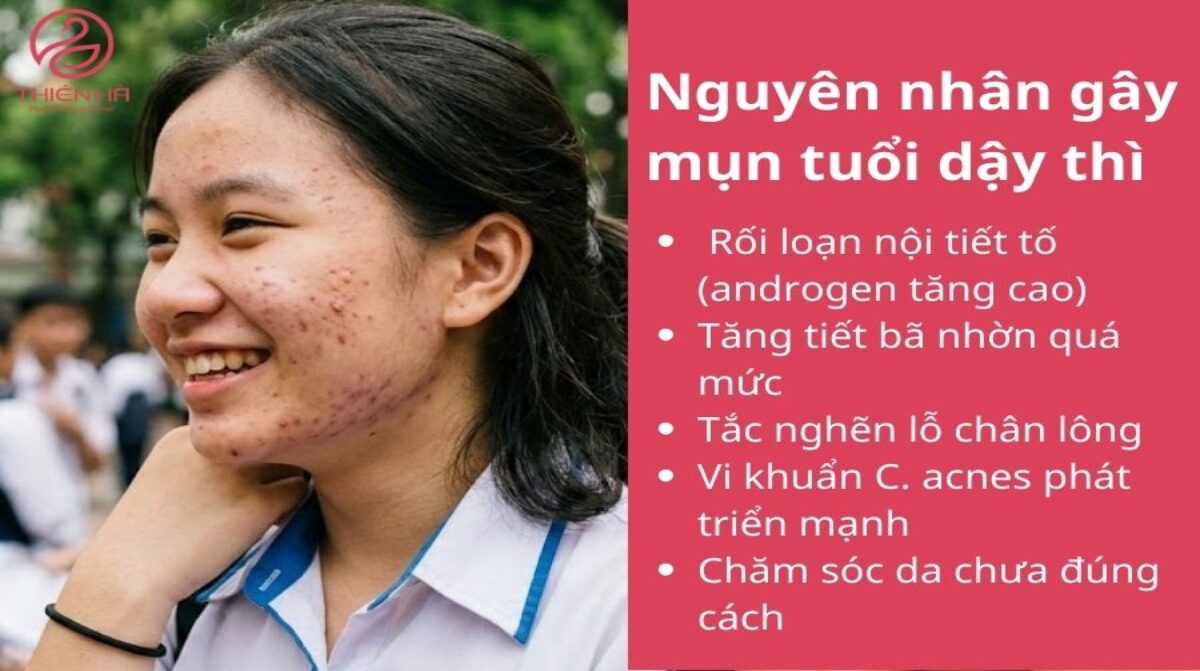 Làm sao để hết mụn tuổi dậy thì? Giải pháp an toàn cho teen