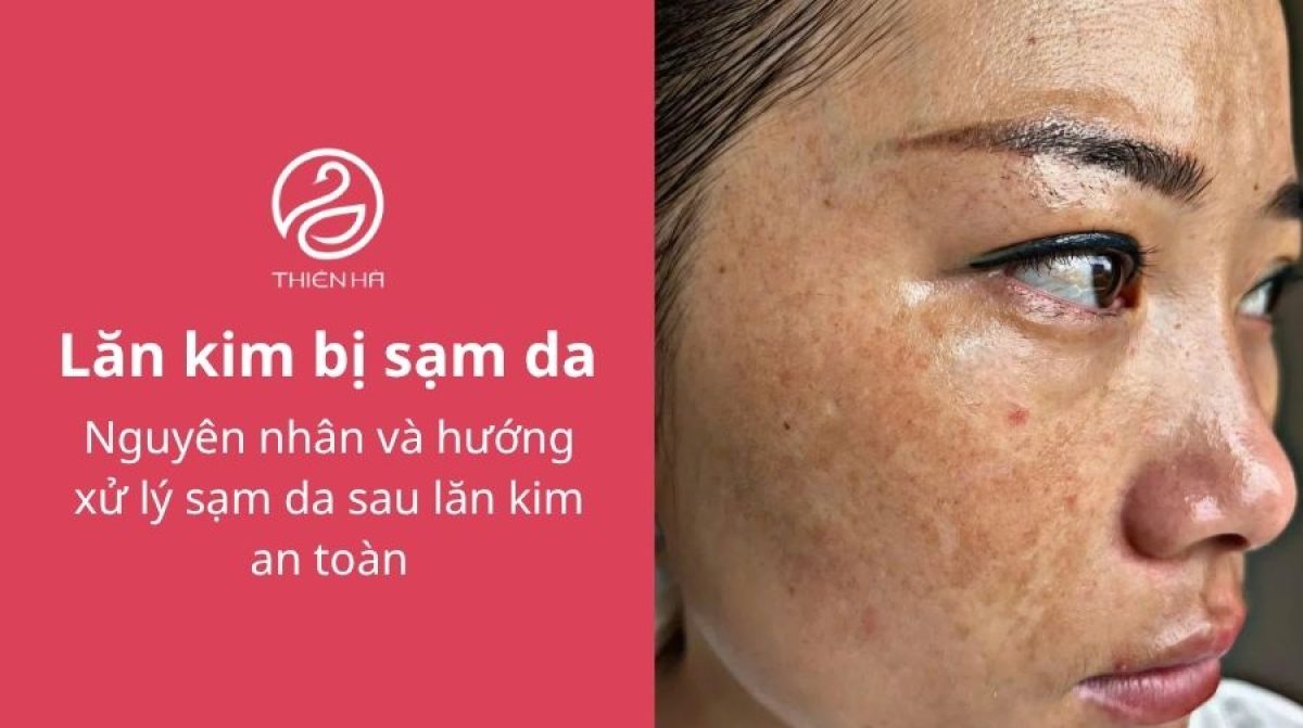 Lăn kim bị sạm da: Nguyên nhân và hướng xử lý an toàn
