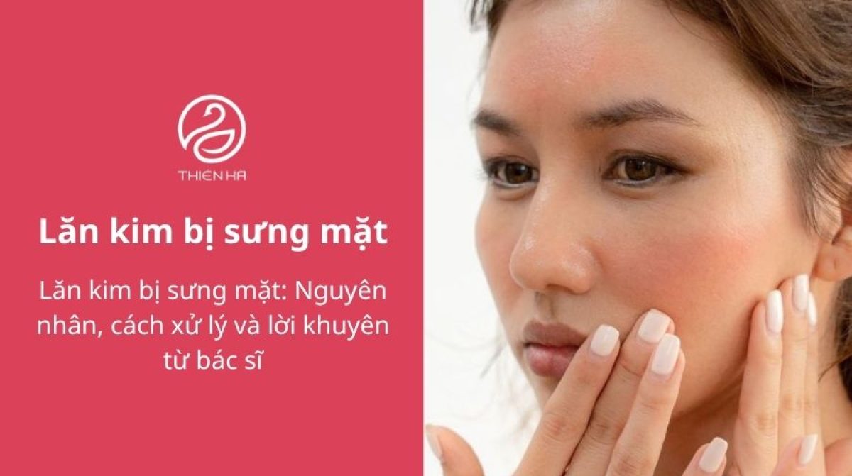 Lăn kim bị sưng mặt: Nguyên nhân, cách xử lý và lời khuyên
