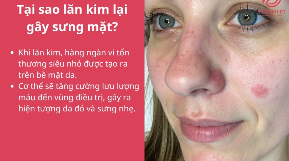 Lăn kim bị sưng mặt: Nguyên nhân, cách xử lý và lời khuyên