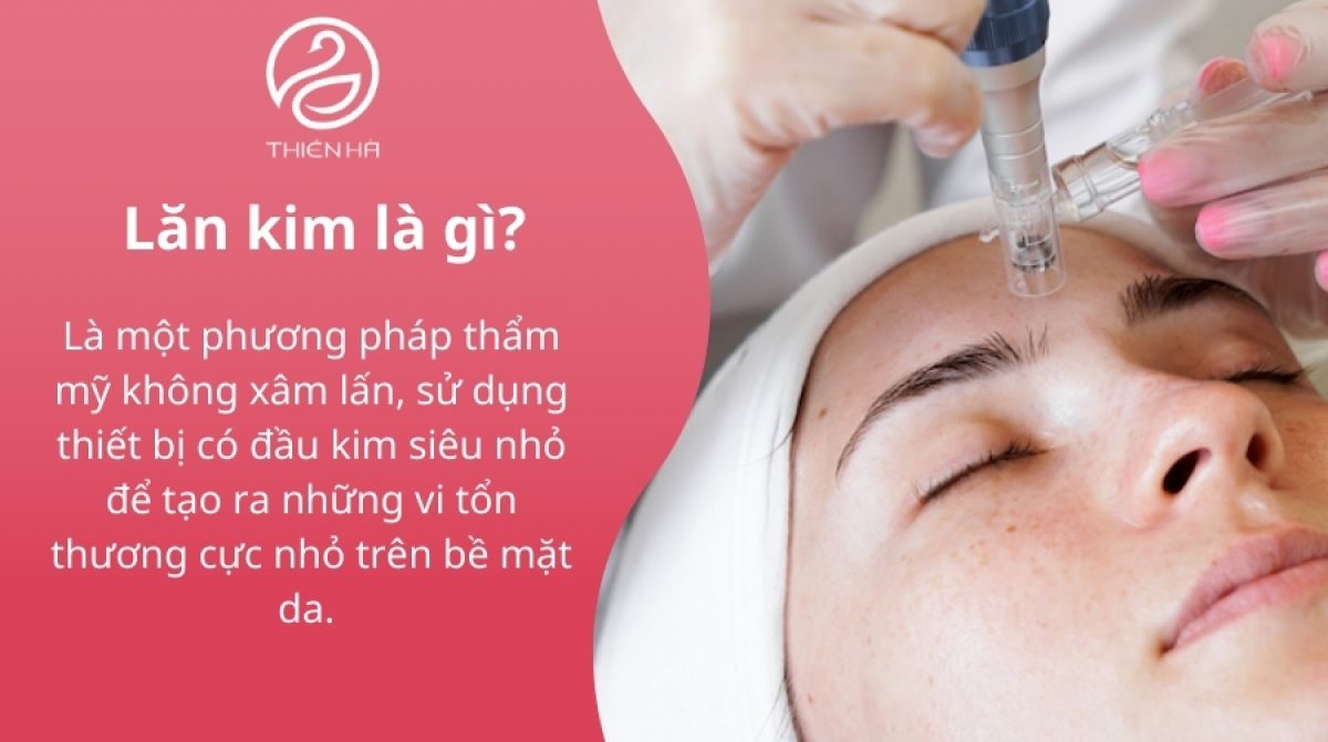 Lăn kim là gì? Lợi ích, quy trình & lưu ý khi lăn kim
