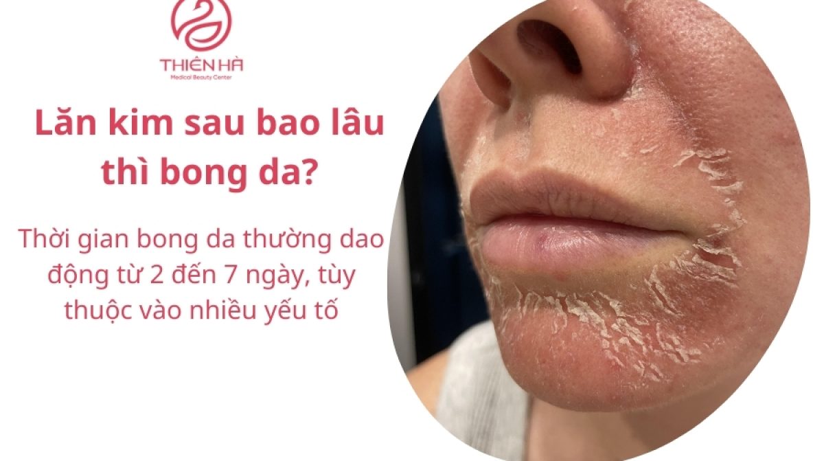 Lăn kim mấy ngày bong da? Quy trình & lưu ý