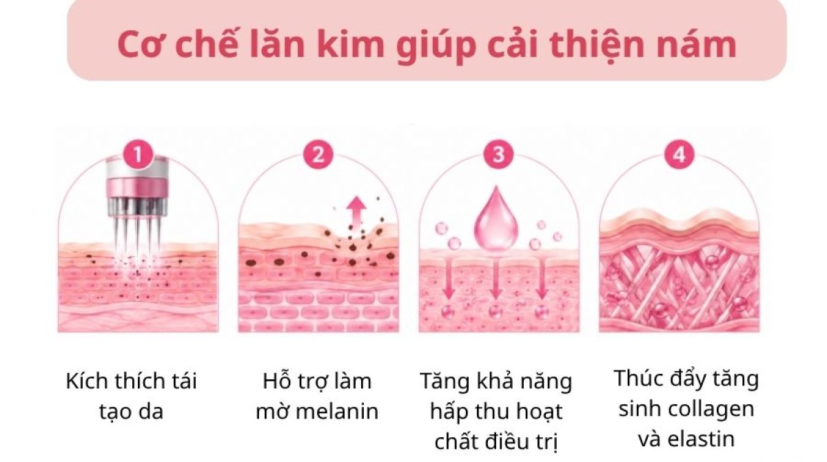 Lăn kim trị nám là gì? Hiệu quả, giá và lưu ý quan trọng