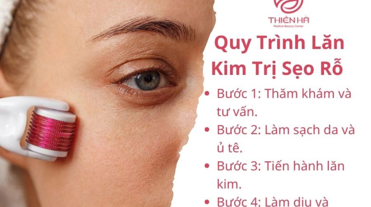 Lăn Kim Trị Sẹo Rỗ: Hiệu Quả, Quy Trình & Chi Phí Tại TMV Thiên Hà