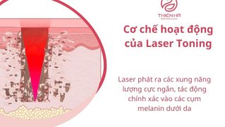 Laser Toning là gì? Công nghệ trị nám, tàn nhang hiệu quả