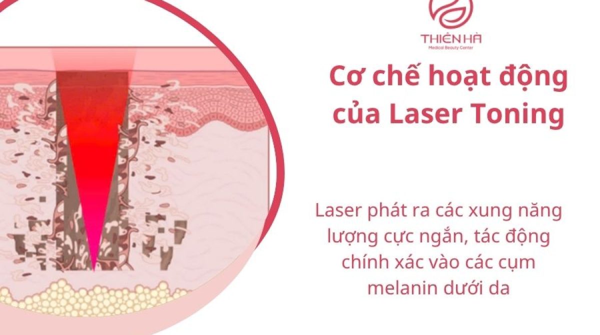 Laser Toning là gì? Công nghệ trị nám, tàn nhang hiệu quả