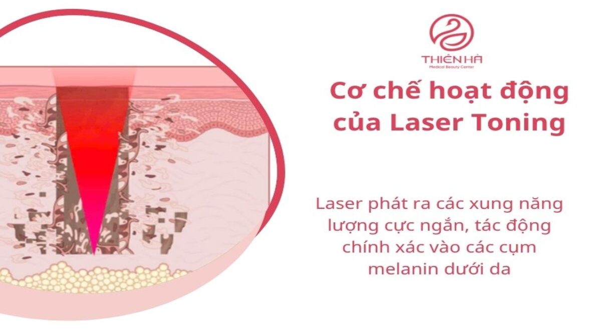Laser Toning là gì? Công nghệ trị nám, tàn nhang hiệu quả