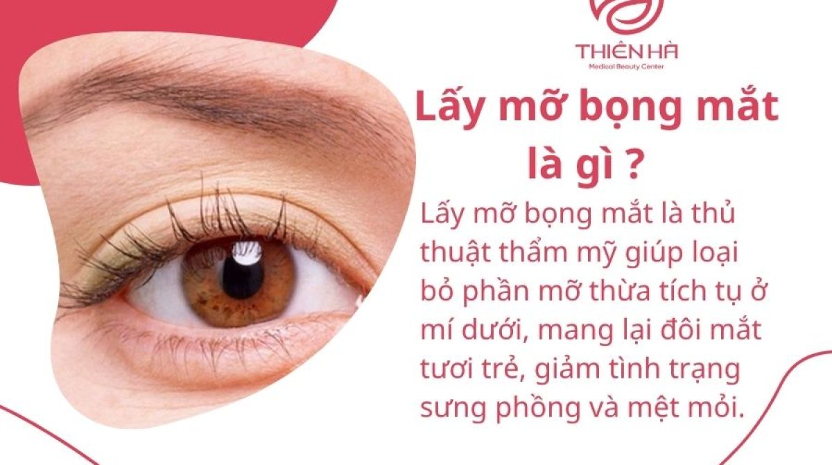 Lấy mỡ bọng mắt là gì ? Quy trình chi phí và cách chăm sóc sau thực hiện