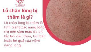 Lỗ chân lông bị thâm: Dấu hiệu, cách dưỡng sáng và phòng ngừa tái phát