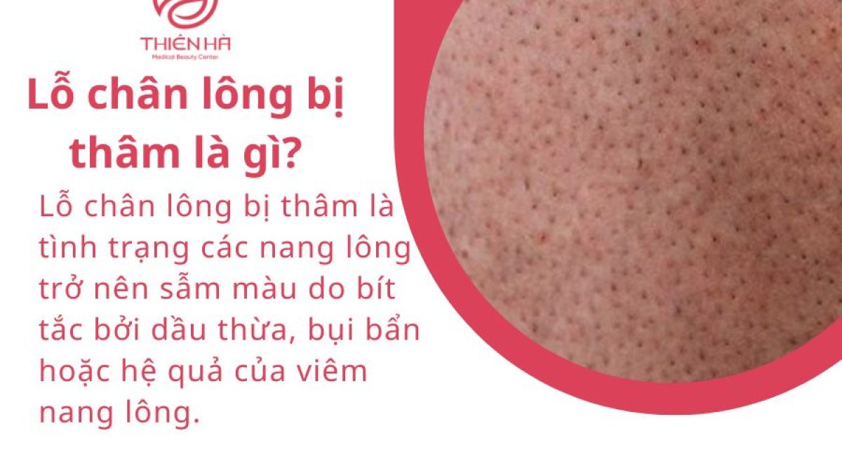 Lỗ chân lông bị thâm: Dấu hiệu, cách dưỡng sáng và phòng ngừa tái phát