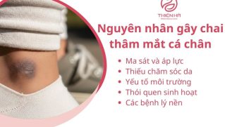 Mắt cá chân bị chai thâm: Nguyên nhân, cách chăm sóc và cải thiện hiệu quả