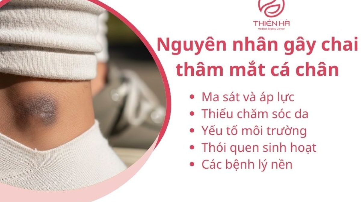 Mắt cá chân bị chai thâm: Nguyên nhân, cách chăm sóc và cải thiện hiệu quả