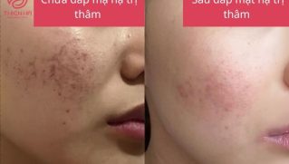 Mặt nạ trị thâm hiệu quả: Hướng dẫn công thức tự nhiên và chuyên sâu