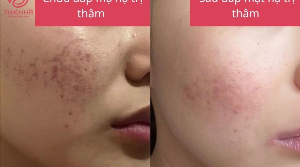 Mặt nạ trị thâm hiệu quả: Hướng dẫn công thức tự nhiên và chuyên sâu