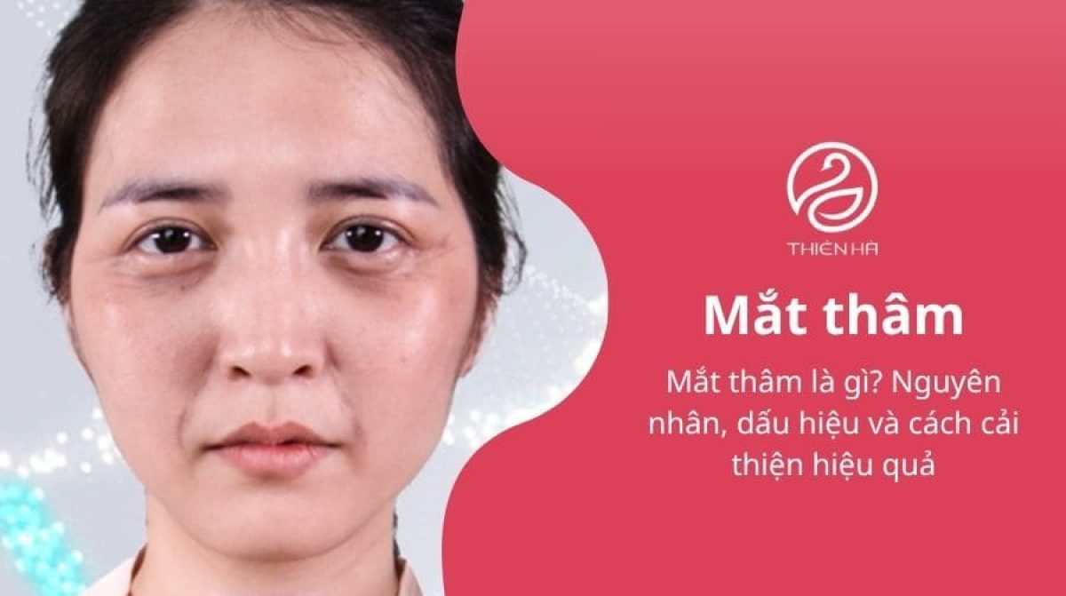 Mắt thâm là gì? Nguyên nhân, dấu hiệu và cách cải thiện hiệu quả