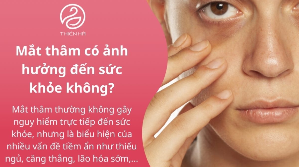 Mắt thâm: Nguyên nhân và cách khắc phục hiệu quả nhất