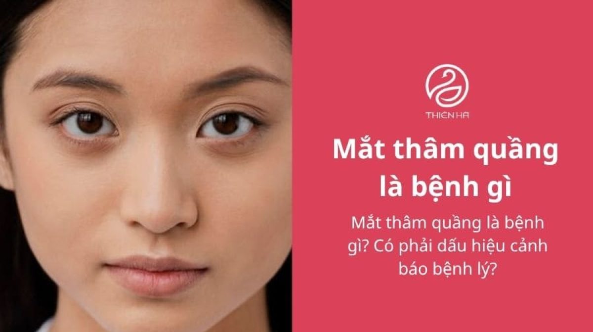 Mắt thâm quầng là bệnh gì? Có phải dấu hiệu cảnh báo bệnh lý?
