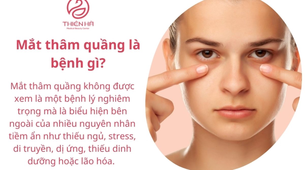 Mắt thâm quầng là bệnh gì? Nguyên nhân và cách điều trị hiệu quả