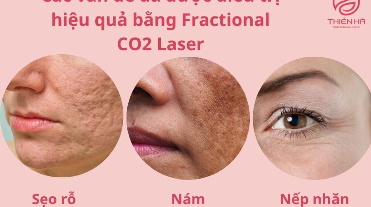Máy Fractional CO2 Laser: Công nghệ trẻ hóa da hiệu quả | Viện thẩm mỹ Thiên Hà
