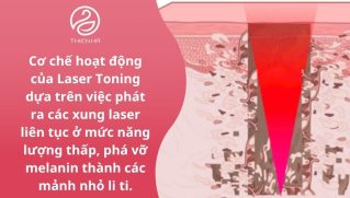 Laser Toning là gì? Công nghệ, hiệu quả và chi phí điều trị