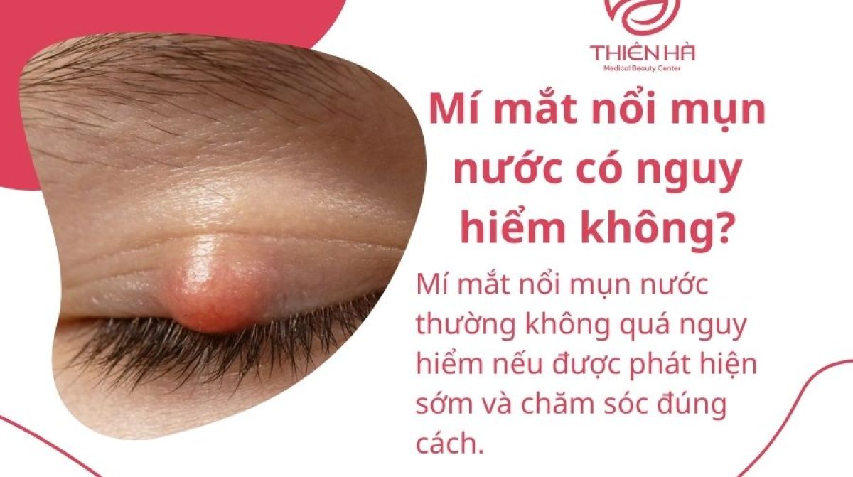 Mí mắt nổi mụn nước: Nguyên nhân, dấu hiệu & cách xử lý an toàn