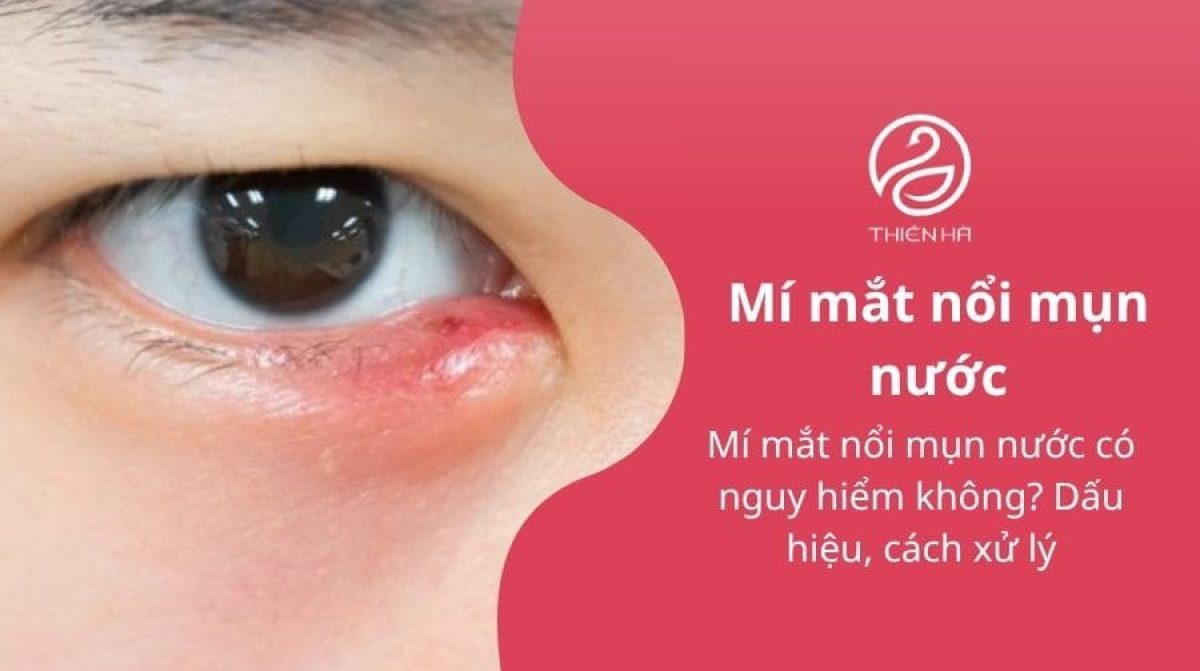 Mí mắt nổi mụn nước: Nguyên nhân thường gặp và cách xử lý đúng