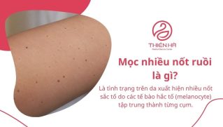 Mọc nhiều nốt ruồi: Có nguy hiểm không và nên xử lý thế nào?