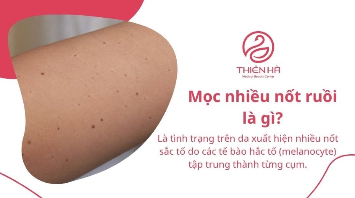 Mọc nhiều nốt ruồi: Có nguy hiểm không và nên xử lý thế nào?