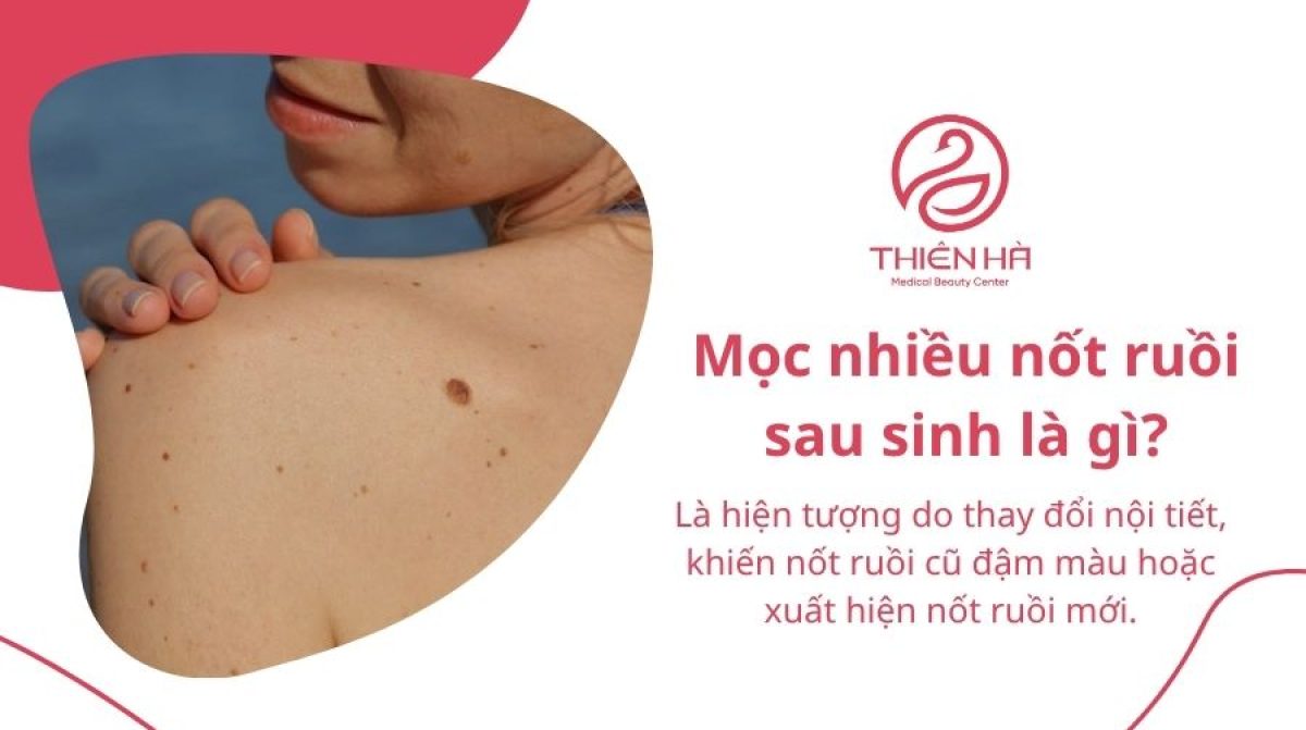 Mọc nhiều nốt ruồi sau sinh: Nguyên nhân và cách xử lý