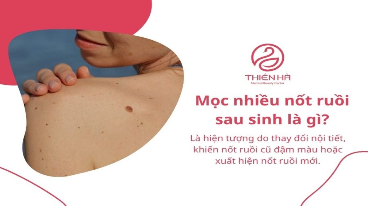 Mọc nhiều nốt ruồi sau sinh: Nguyên nhân và cách xử lý