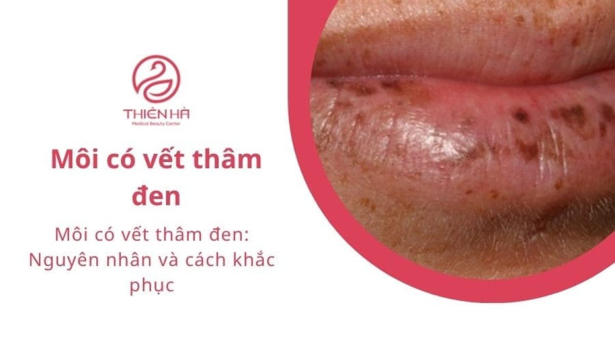 Môi có vết thâm đen: Nguyên nhân và cách khắc phục