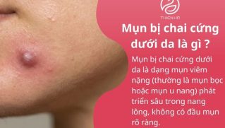 Mụn bị chai cứng dưới da phải làm sao? Cách xử lý an toàn