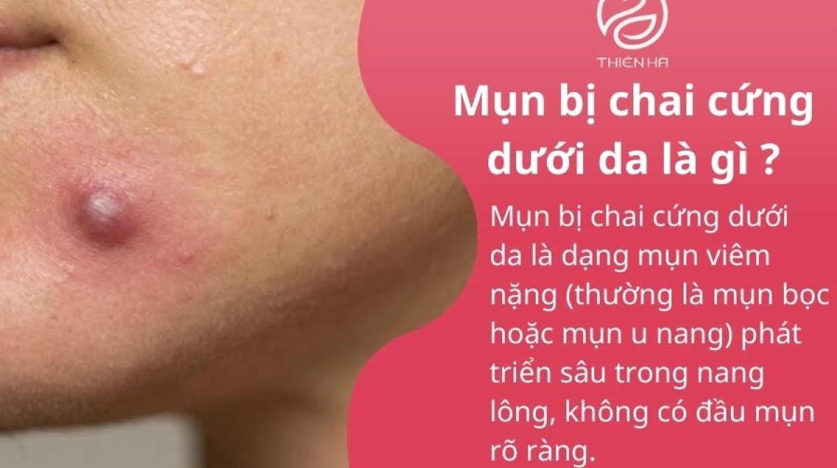 Mụn bị chai cứng dưới da phải làm sao? Cách xử lý an toàn